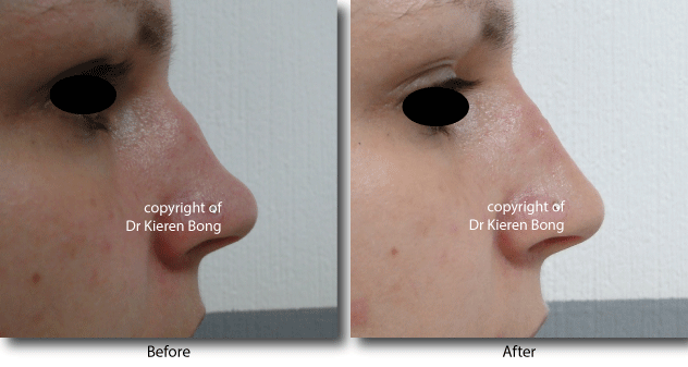 Non surgical Nose Reshaping