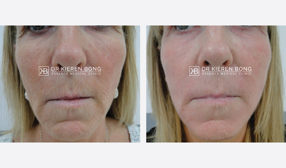 Phenol Chemical Skin Peel Glasgow Facial Chemical Peel Specialist Essence Medical Cosmetic Clinic