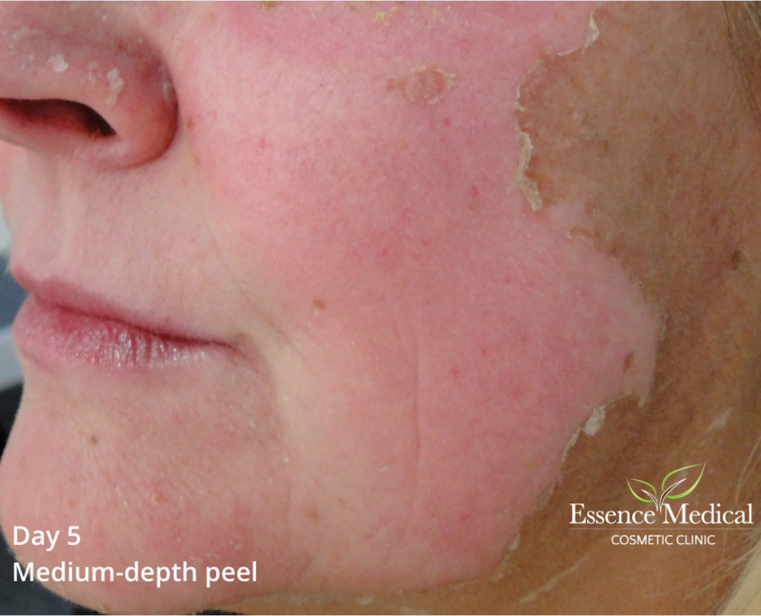 Medical Skin Peel Glasgow, Facial Chemical Peel Specialist Essence