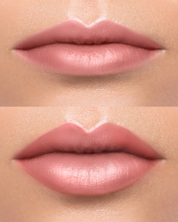 Dermal Lip Fillers