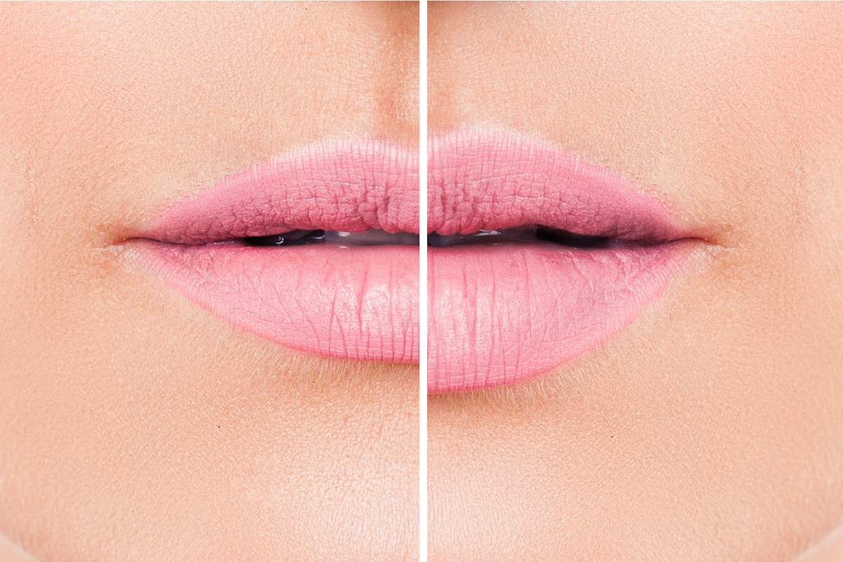 Thin lip treatment