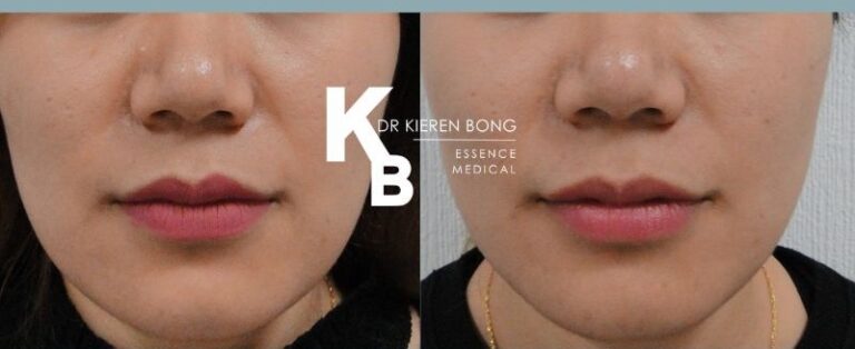 Botox - Jawline Masseter Reduction Jawline Slimming before and after picture