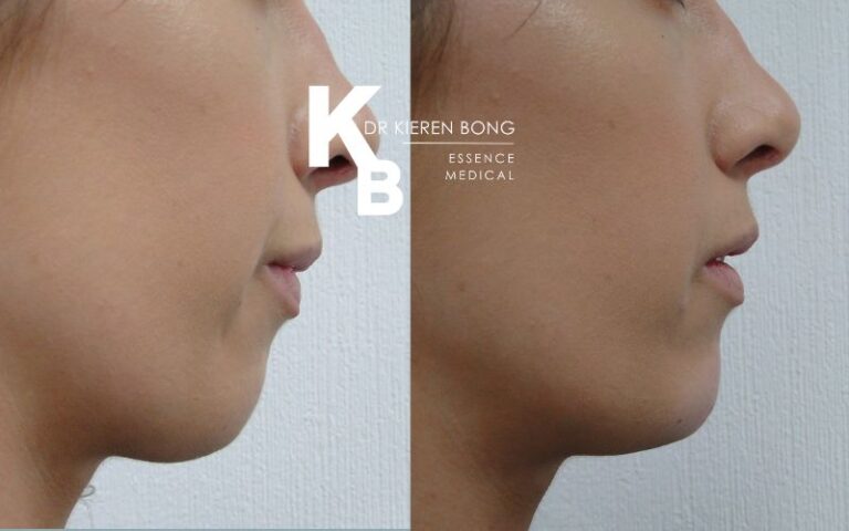 Chin and cheek filler Augmentation Before and After Pictures