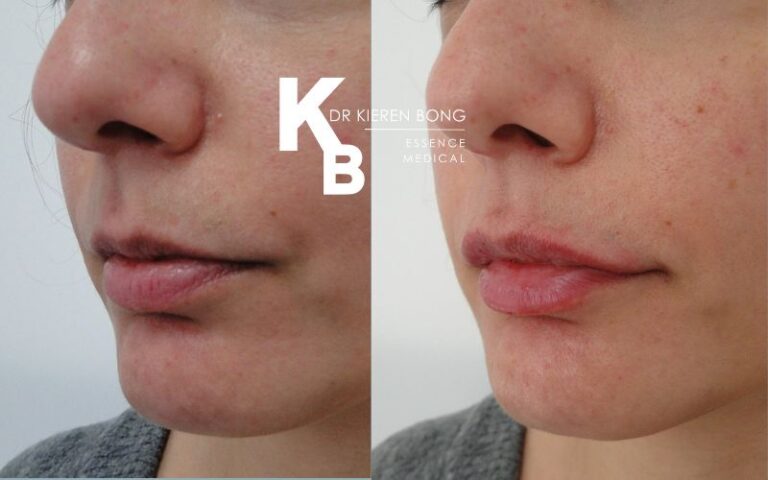 Chin and cheek filler Augmentation Before and After Pictures