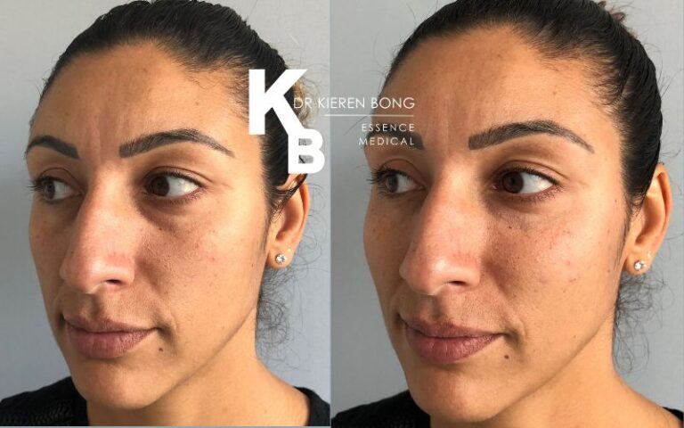 Chin and cheek filler Augmentation Before and After Pictures