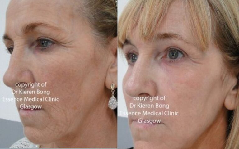 Deep phenol skin peel Before and After Pictures