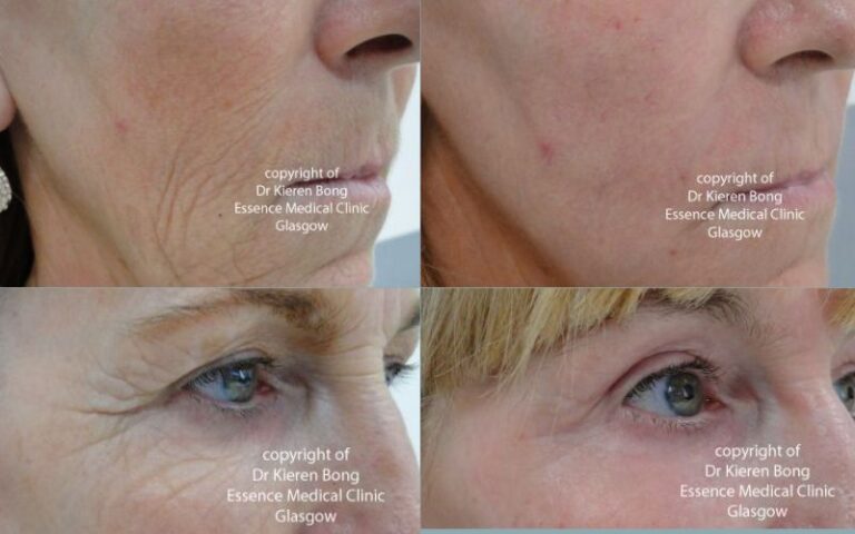 Phenol Chemical Skin Deep Peel  Glasgow