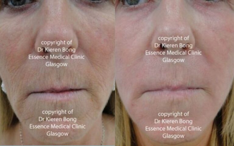 Deep phenol skin peel Before and After Pictures