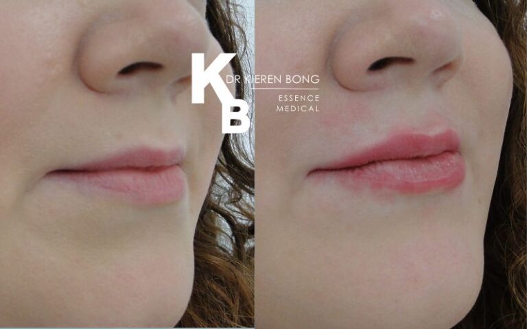 Lip Fillers Before and After Pictures