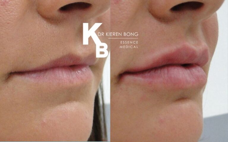 Lip Fillers Before and After Pictures