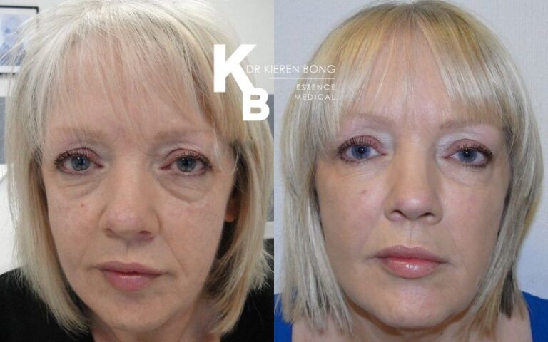 Liquid Face Lift Dermal Fillers Before and After Pictures