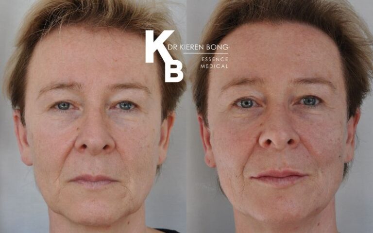 Liquid Face Lift Dermal Fillers Before and After Pictures