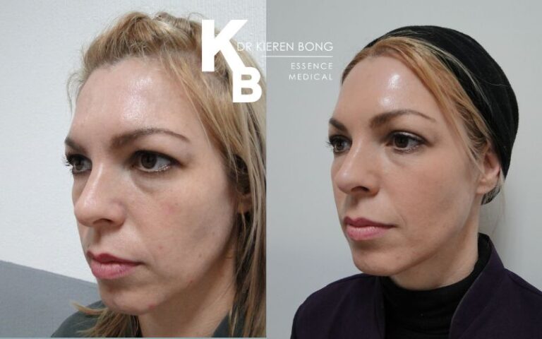 Medium Chemical Skin Peel Before and After Pictures