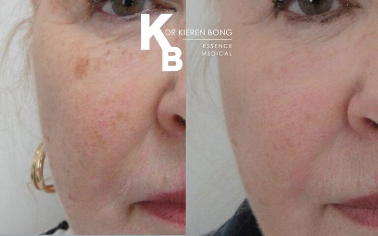 Medium Chemical Skin Peel Before and After Pictures