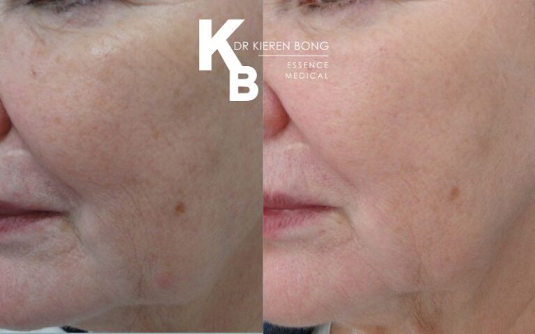 Medium Chemical Skin Peel Before and After Pictures