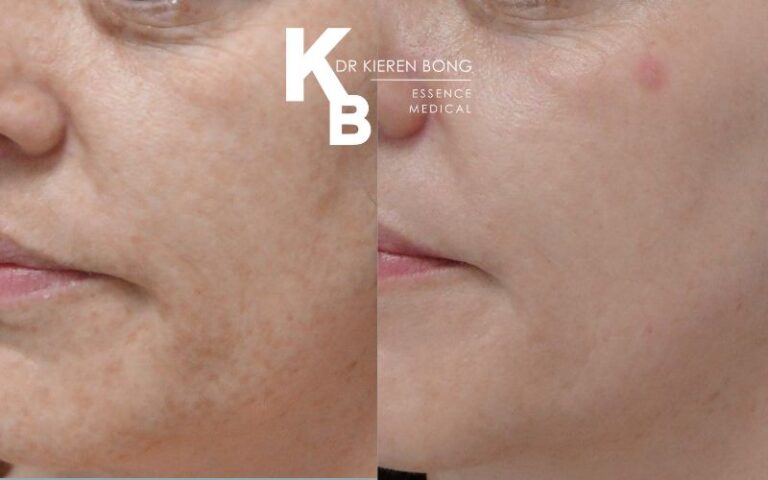 Medium Chemical Skin Peel Before and After Pictures