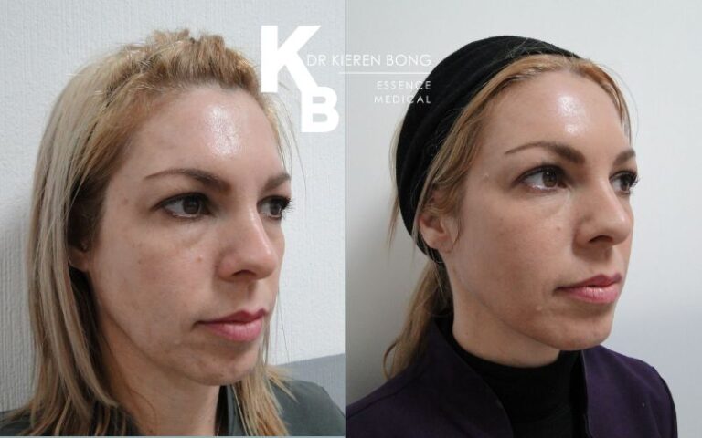 Medium Chemical Skin Peel Before and After Pictures