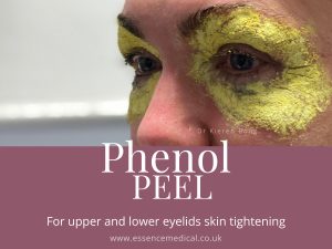 Phenol Face Peel