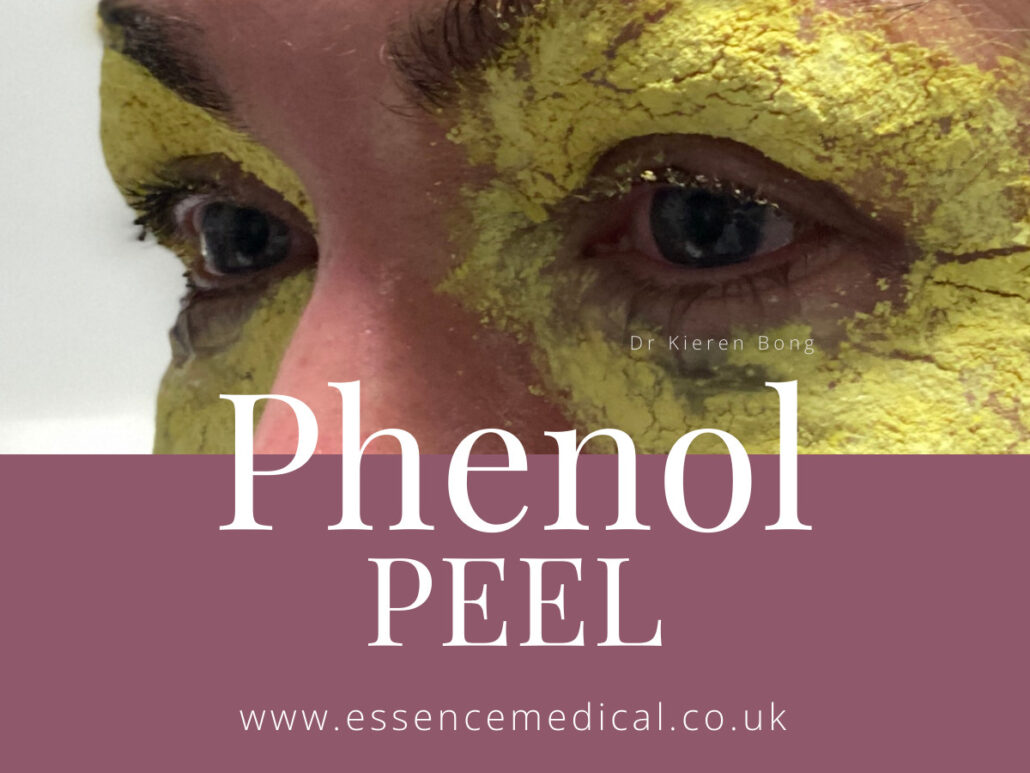 Phenol Peel