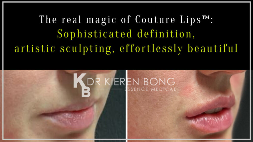 Couture Lips - transforming lip fillers