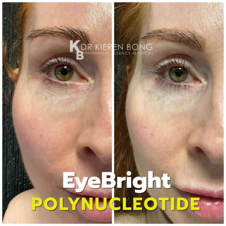 Polynucleotide Undereye treatment