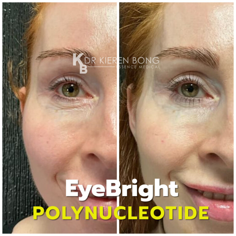 Polynucleotide EyeBright undereye treatment