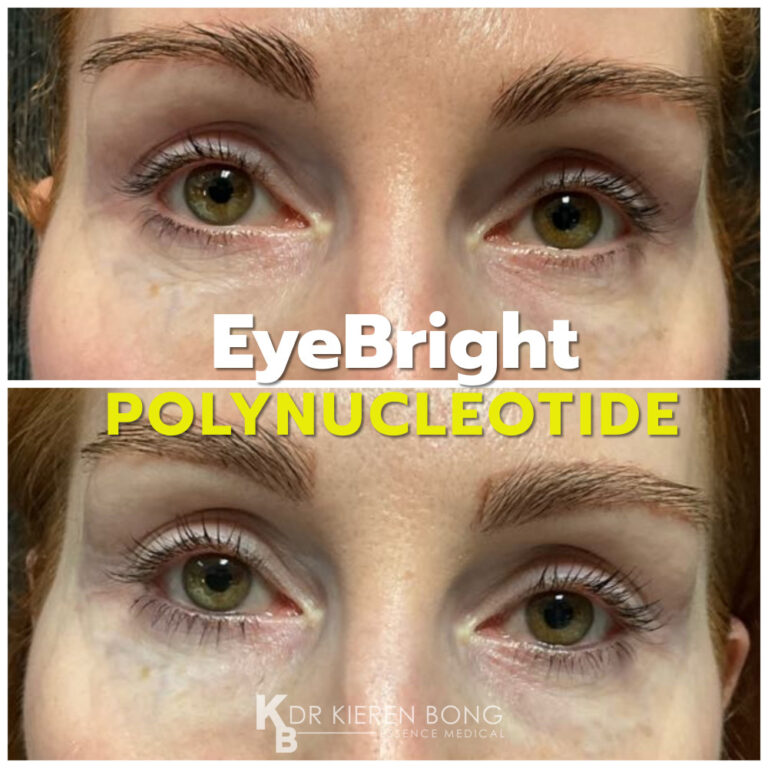 Polynucleotide EyeBright Undereye treatment