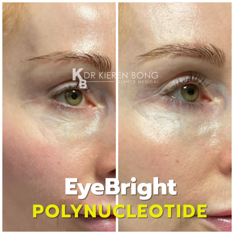 Polynucleotide EyeBright Undereye treatment